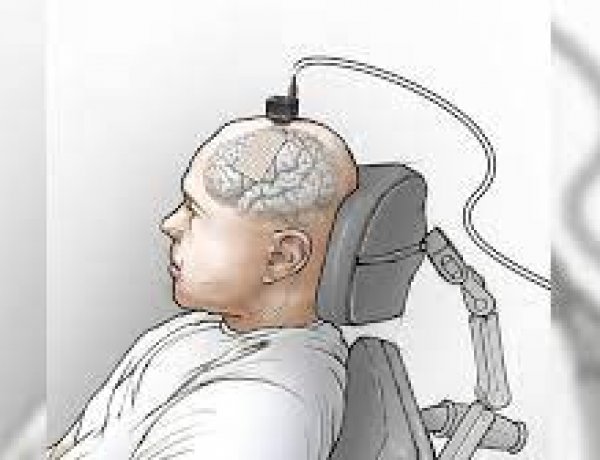 Thiết bị cấy ghép não giúp người bị liệt ‘nói chuyện’